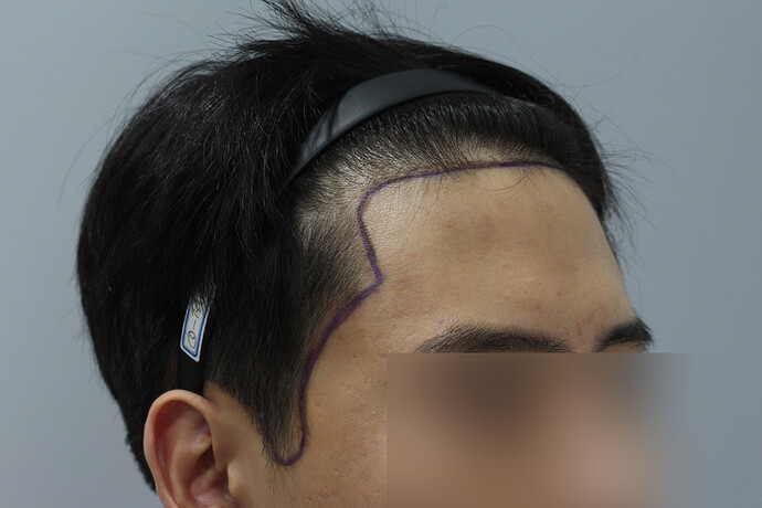 Before Surgery 1.jpg