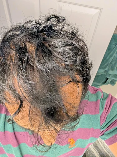 suggestions-to-reduce-hairloss-and-possible-growth-v0-n7cnso699s3h1