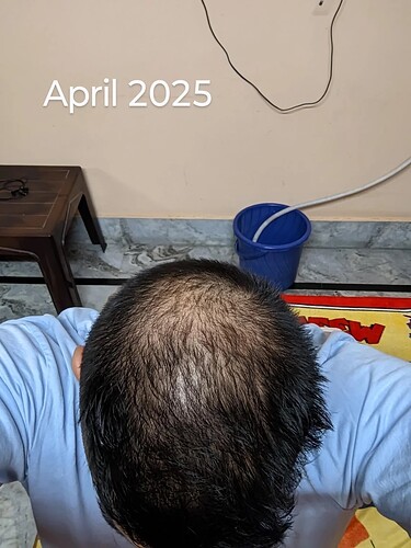 should-i-wait-more-before-thinking-about-crown-hair-v0-cfeuhdjeaqwe1