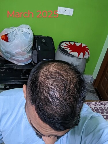 should-i-wait-more-before-thinking-about-crown-hair-v0-gtht6xbeaqwe1