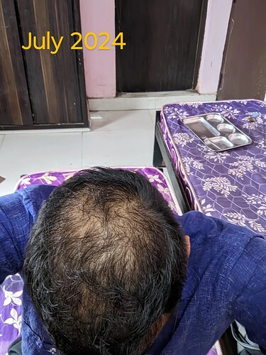 should-i-wait-more-before-thinking-about-crown-hair-v0-i6d7h6odaqwe1