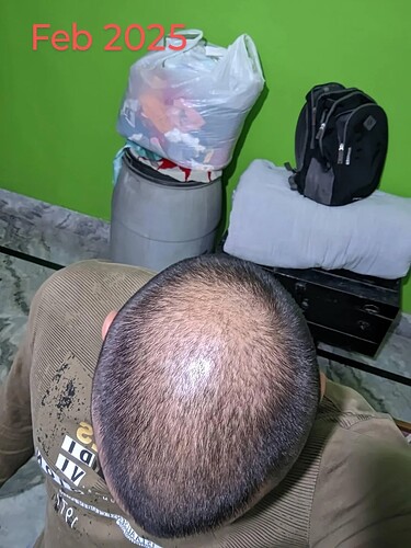 should-i-wait-more-before-thinking-about-crown-hair-v0-2vbt0j7eaqwe1