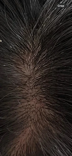 early-thinning-finasteride-2-weeks-in-should-i-add-v0-88jaf6xkbrhf1