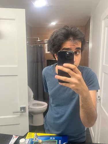 weird-hairloss-pattern-localized-to-my-front-scalp-v0-f9fpkjtewl0g1