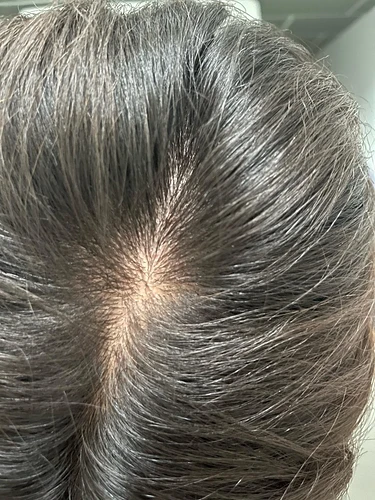 early-thinning-finasteride-2-weeks-in-should-i-add-v0-29z9ueeibrhf1