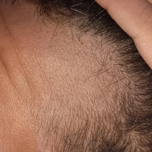 some-progress-here-1-month-progression-v0-k5c5f66btb8f1