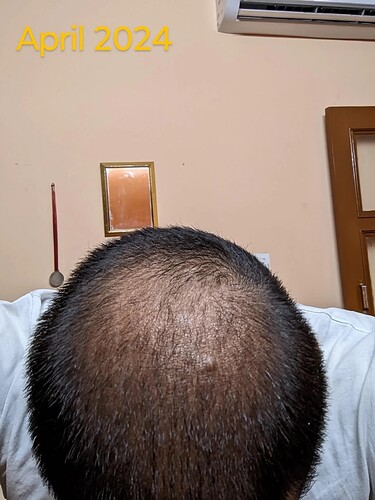 should-i-wait-more-before-thinking-about-crown-hair-v0-1s5po8kdaqwe1
