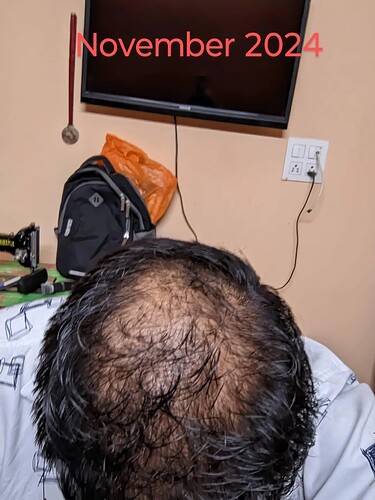 should-i-wait-more-before-thinking-about-crown-hair-v0-waxk8lydaqwe1