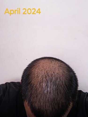 should-i-wait-more-before-thinking-about-crown-hair-v0-qz9n2bgdaqwe1