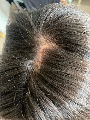 early-thinning-finasteride-2-weeks-in-should-i-add-v0-ckb4zm5nbrhf1