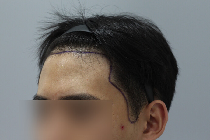 Before Surgery 2.jpg