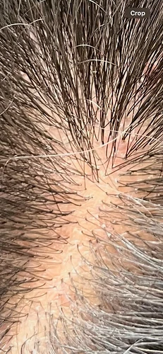 early-thinning-finasteride-2-weeks-in-should-i-add-v0-yzshilijbrhf1