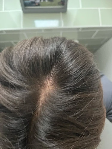 early-thinning-finasteride-2-weeks-in-should-i-add-v0-i5apygwhbrhf1