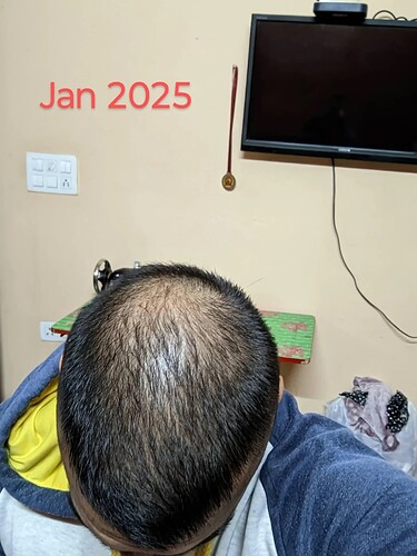 should-i-wait-more-before-thinking-about-crown-hair-v0-2authq1eaqwe1