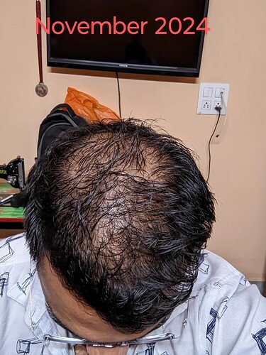 should-i-wait-more-before-thinking-about-crown-hair-v0-vptsftudaqwe1