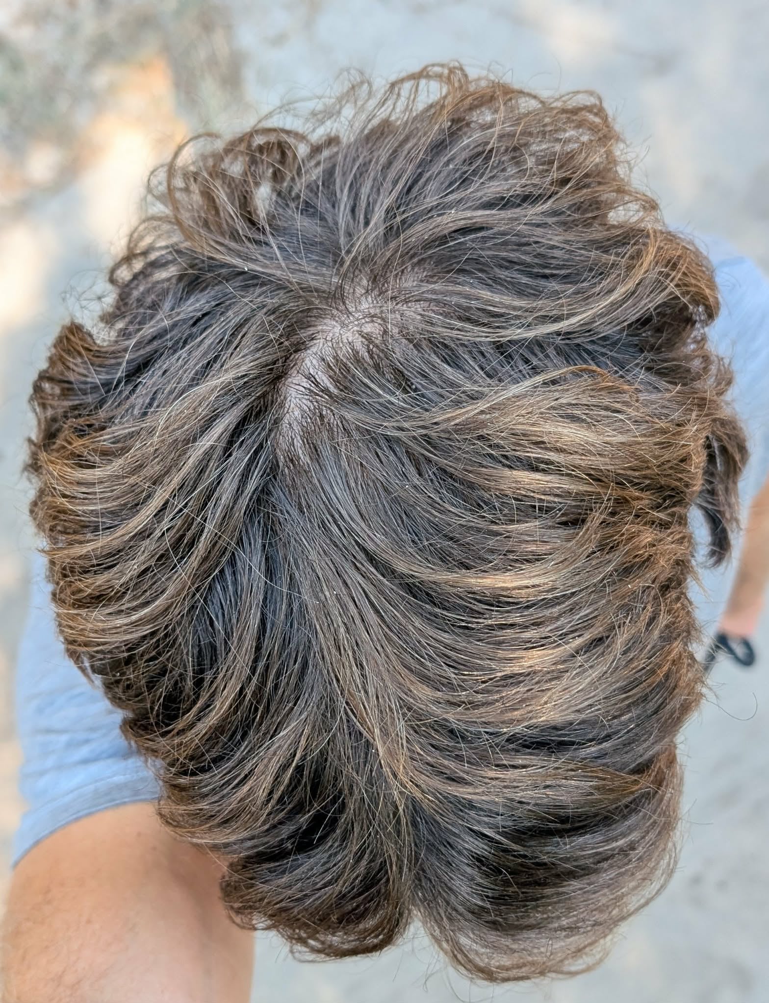 r/tressless - 33M - Should I stick with topical finasteride or switch to oral?|574.4992672203224xauto