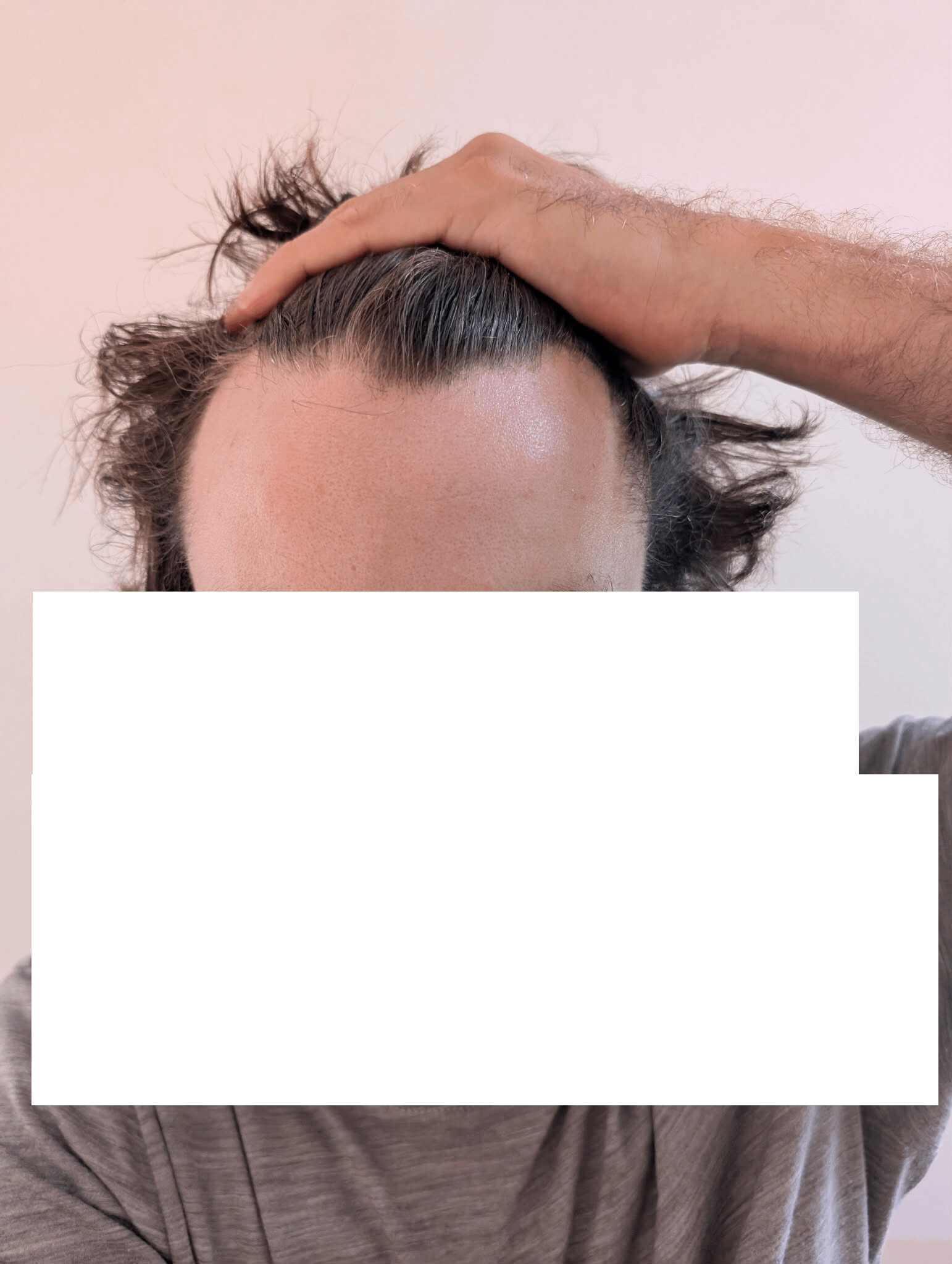 r/tressless - 33M - Should I stick with topical finasteride or switch to oral?|564.9731314118221xauto